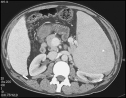 Splenomegaly- Lymphoma - CTisus CT Scan