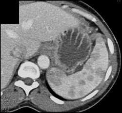 Splenic Lymphoma - CTisus CT Scan