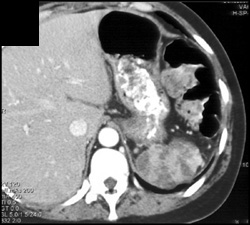 Old Splenic Infarcts - CTisus CT Scan