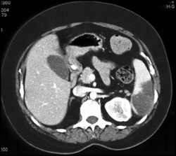 Splenic Infarcts - CTisus CT Scan