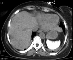 Sickle Cell Disease - CTisus CT Scan