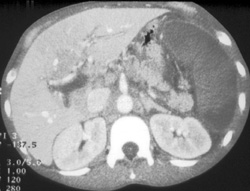 Global Splenic Infarction With Portal Vein Thrombosis - CTisus CT Scan