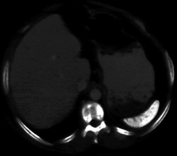 Sickle Cell Disease - CTisus CT Scan