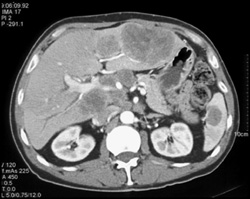 Metastatic Bladder Cancer - CTisus CT Scan