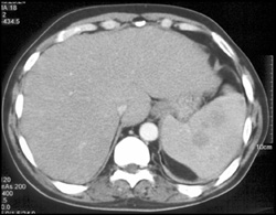 Splenic Lymphoma - CTisus CT Scan