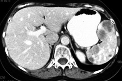 Splenic Lymphoma - CTisus CT Scan