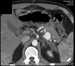 Splenic Artery Pseudoaneurysm - CTisus CT Scan