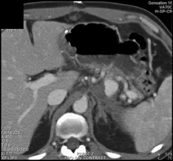 Splenic Artery Pseudoaneurysm - CTisus CT Scan