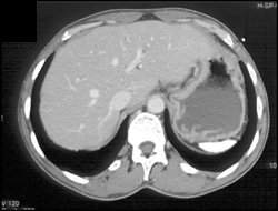 Sickle Cell Disease With Infarcted Spleen - CTisus CT Scan