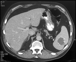 Splenic Hemangioma - CTisus CT Scan