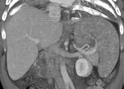 Sarcoidosis - CTisus CT Scan