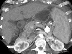 Splenic Artery Aneurysm - CTisus CT Scan