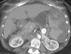 Splenic Artery Aneurysm - CTisus CT Scan