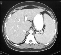 Splenomegaly Due to Portal Hypertension - CTisus CT Scan