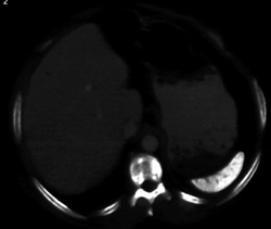 Sickle Cell Disease - CTisus CT Scan