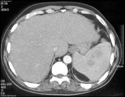 Lymphoma - CTisus CT Scan