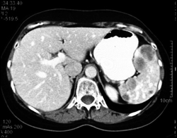 Lymphoma - CTisus CT Scan