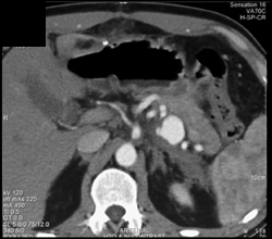 Splenic Artery Pseudoaneurysm - CTisus CT Scan