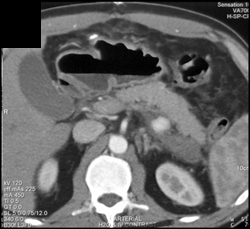 Splenic Artery Pseudoaneurysm - CTisus CT Scan