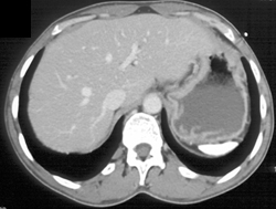 Sickle Cell Disease - CTisus CT Scan