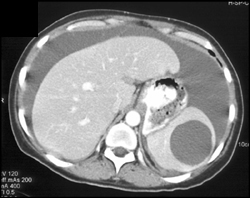 Splenic Cyst - CTisus CT Scan