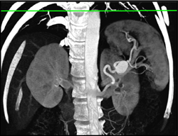 Splenic Artery Aneurysm - CTisus CT Scan