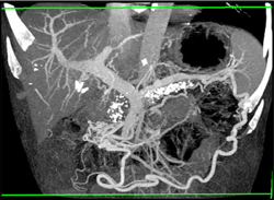 Cirrhosis With Varices and Chronic Pancreatitis - CTisus CT Scan