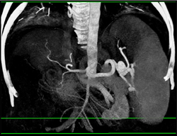 Splenic Artery Aneurysm - CTisus CT Scan