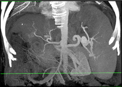 Splenic Artery Aneurysm - CTisus CT Scan