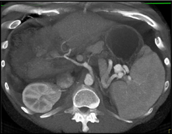 Splenic Artery Aneurysm - CTisus CT Scan