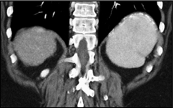 Calcified Spleen Due to Trauma - CTisus CT Scan