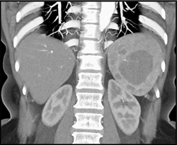 Hamartoma - CTisus CT Scan