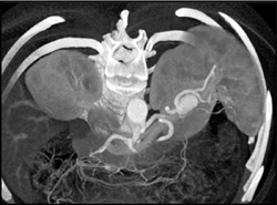 Splenic Aa Aneurysm - CTisus CT Scan