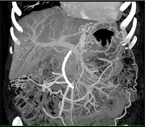 Occluded Splenic Vein Due to Pancreatic Cancer - CTisus CT Scan