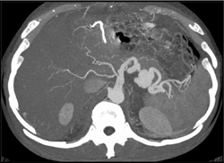 Splenic Artery Pseudoaneurysm - CTisus CT Scan