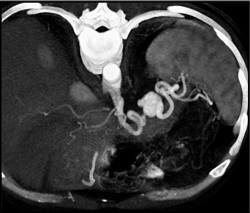 Splenic Artery Pseudoaneurysm - CTisus CT Scan