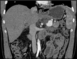 Splenic Artery Pseudoaneurysm - CTisus CT Scan