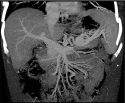 Splenic Artery Pseudoaneurysm - CTisus CT Scan