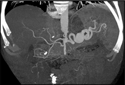 Splenic Artery Pseudoaneurysm - CTisus CT Scan