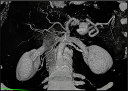 Splenic Artery Pseudoaneurysm - CTisus CT Scan