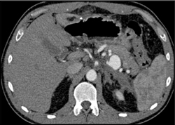 Splenic Artery Pseudoaneurysm - CTisus CT Scan