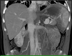 Splenic Artery Pseudoaneurysm - CTisus CT Scan