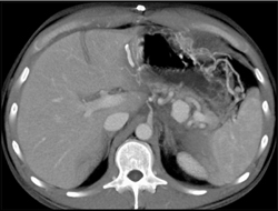 Splenic Artery Pseudoaneurysm - CTisus CT Scan