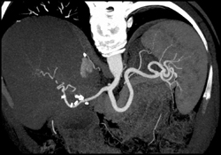 Normal Splenic Artery - CTisus CT Scan