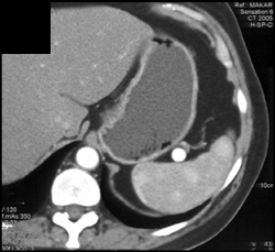 Splenic Artery Aneurysm - CTisus CT Scan