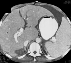 Splenic Artery Aneurysm - CTisus CT Scan