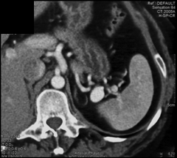 Splenic Artery Aneurysm - CTisus CT Scan