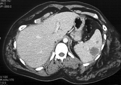 Hemangioma of the Spleen - CTisus CT Scan