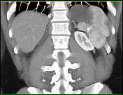 Accessory Spleens - CTisus CT Scan