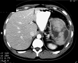 Splenic Abscess - CTisus CT Scan